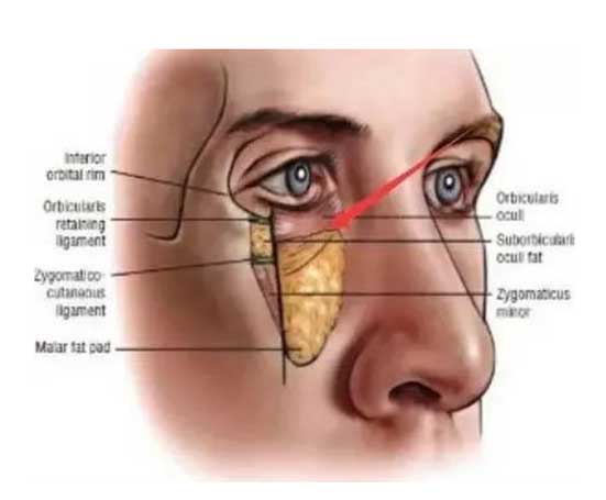 眼袋是什么引起的
