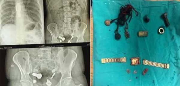 男子呕吐就医,体内取出手表铁片