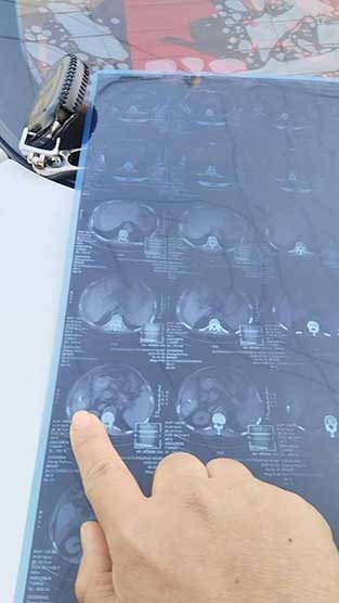 震惊！两患者同天手术被遗钻头，医院隐瞒数月