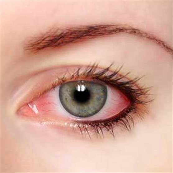 戴美瞳后眼睛冒分泌物？这是眼睛在求救！