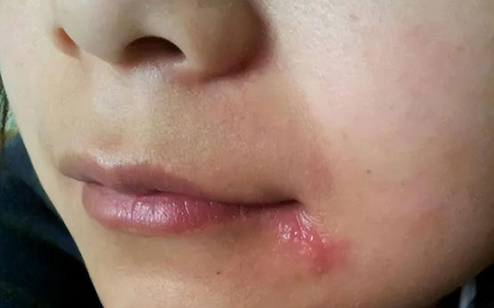 嘴角长水泡未重视 当晚脑死亡