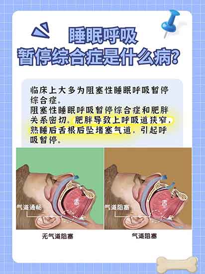 睡眠呼吸暂停有多危险？男子 1 年撞 3 辆豪车，症状危害与自救指南