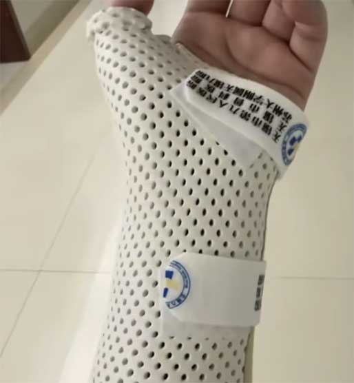 女子被15斤猫咪压整夜,手腕竟骨折!