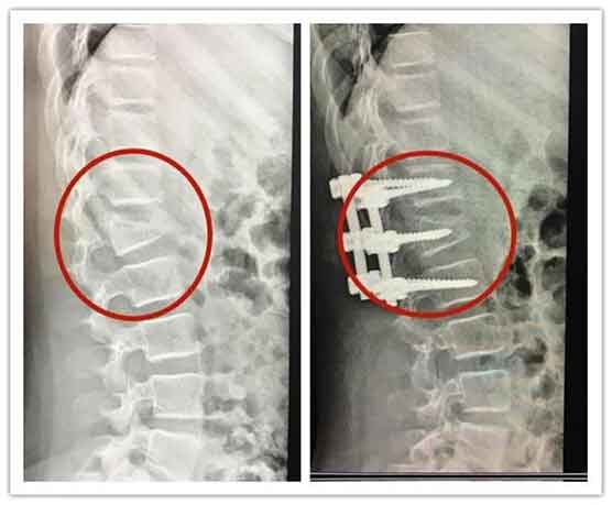 25岁女孩玩手机踩空 腰椎爆裂骨折或致瘫痪
